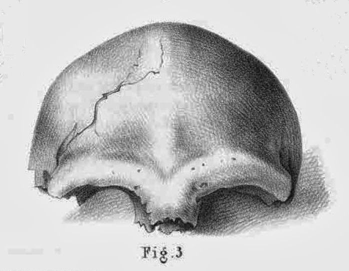 Neandertal 1, Holotype specimen of Homo neanderthalensis by Johann Karl Fuhlrott
