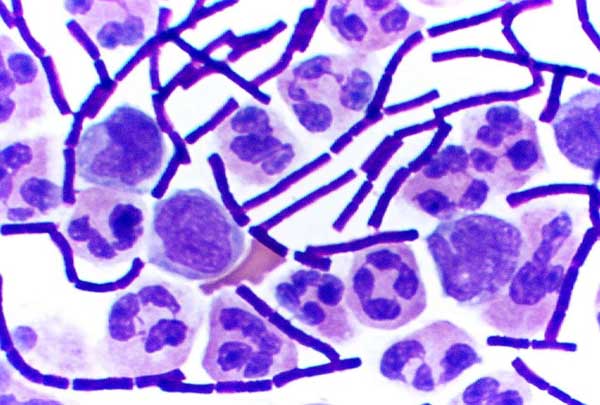 Gram stained cerebrospinal fluid showing gram-positive anthrax baccilli (purple rods)