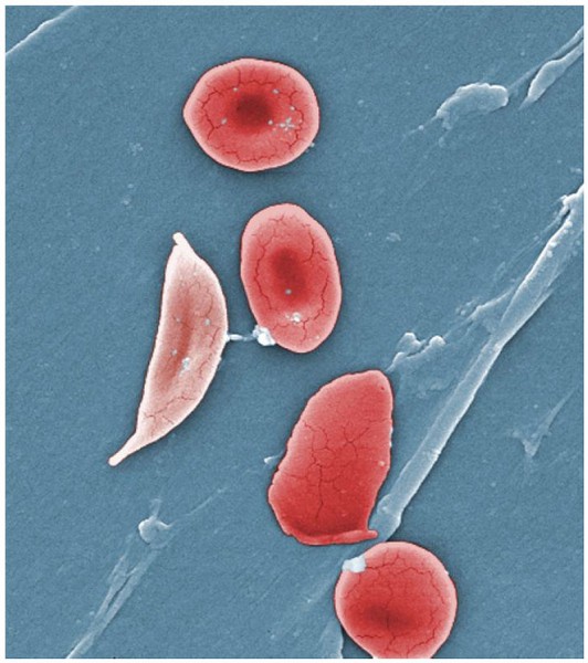 Normal blood cells next to a sickle-blood cell, colored scanning electron microscope image