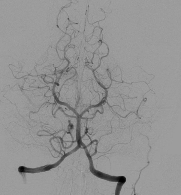Cerebral angiography, injection in the left vertebral artery, with retrograde flow in the contralateral vertebral artery, the basilar artery and the posterior communicating artery. The posterior cerebral circulation can be seen, including the posterior part of the Circle of Willis.