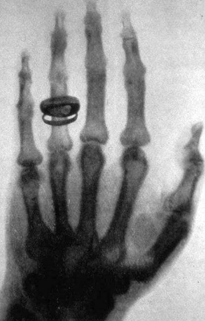 X-ray image: Albert von Koellikers hand, taken by Conrad Röntgen on 23 January 1896