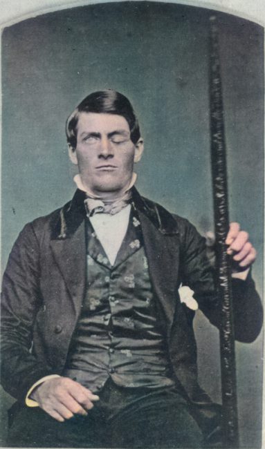 Phineas Gage (1823–1860)